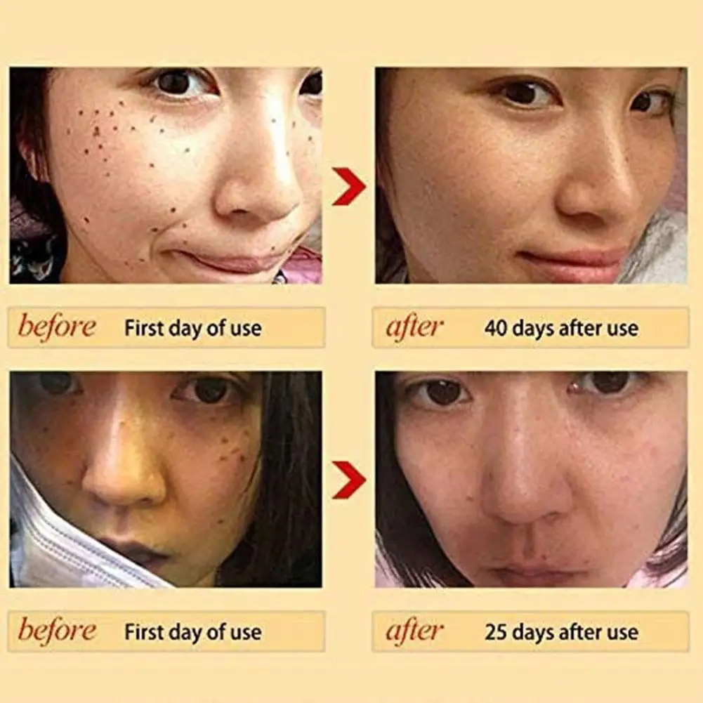 Face Serum Whitening Skin Care Freckle Removal Acne Scar - Image 5